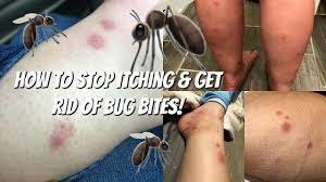 stop itching get rid of bug bites
