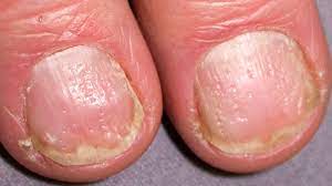 nail pitting causes treatment and more