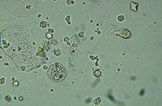21 Best Urine Microscopic Images Medical Laboratory