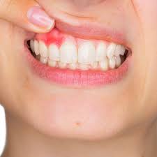 receding gums causes symptoms and