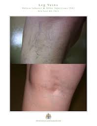 leg veins and spider vein treatment