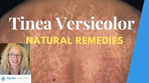 home remes for tinea versicolor