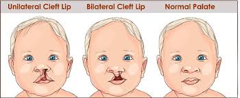 understanding cleft lip and palate