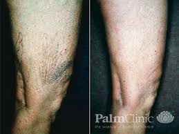 broken veins on thighs palm clinic