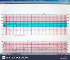 Computer Screen Monitoring Vital Signs And Contractions Of