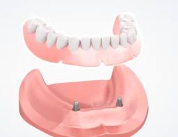 How to clean & care for your dentures. Gunstige Coverdenture Mit 4 Jahren Garantie Zahnersatzsparen De