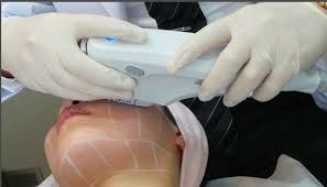 Image result for ultherapy machine