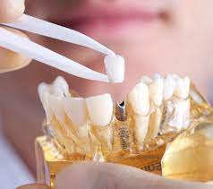 implant dentar design clinic