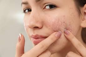 cystic acne home remes how to
