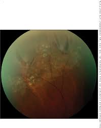 retinal physician pentavision