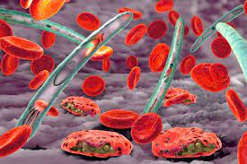 Unless it is diagnosed and treated promptly, it can be fatal. New Set Of Channels Between Malaria Parasite And Blood Cells Discovered