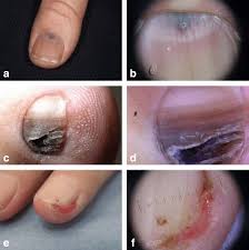 common nail disorders