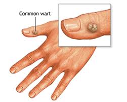 home remes for wart natural treatment