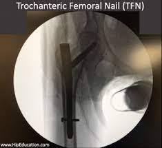 trochanteric fem nail hipeducation