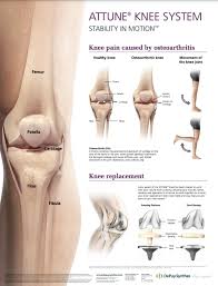 total knee joint replacement dr