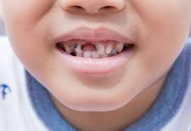 fighting tooth decay in children