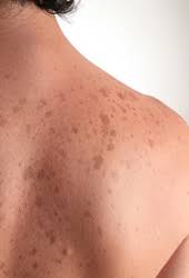 skin discoloration lincolnshire il