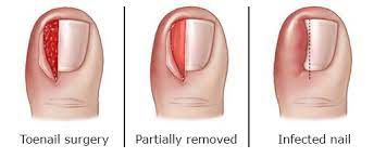 ingrown toenail treatment