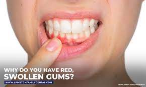 why do you have red swollen gums