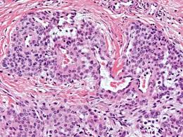 glomus tumor pathology orthobullets