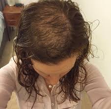 cover up bald patches