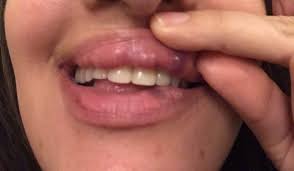 botched lip filler treatment