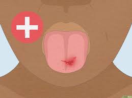 how to heal a cut on your tongue fast