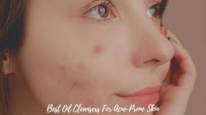 13 best oil cleansers for acne e skin