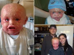 A newborn whose skin is covered in a thick, rough scales that are separated by red grooves. Stay Away From That Child He S Contagious Mother Tells How Son With Rare Fish Scale Illness Was Shunned Mirror Online