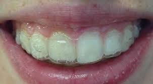Some are simple and fast, others will take months. Blog Posts A Straighter Smile Take Two
