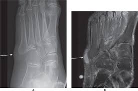 New msk mri course online foot & toes 2021 covers the complex anatomy & common abnormalities in reporting. 25 Magnetic Resonance Imaging Of Foot And Ankle Pathology Musculoskeletal Key