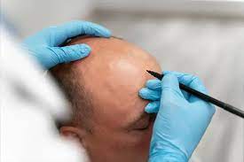 Hair Transplant Turkey Cost 2024 and Packages - Mayclinik