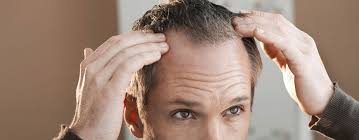Check spelling or type a new query. Crown Hair Transplant Growth Time Timeline Clinicana