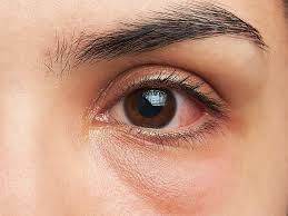 stye on lower eyelid symptoms causes