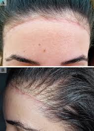 trichotillomania and traction alopecia