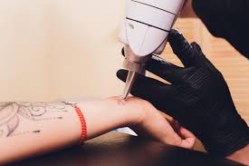 r20 method of laser tattoo removal