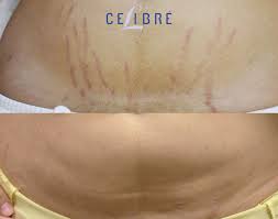 stretch mark removal before and after