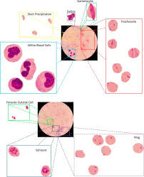 Image Analysis And Machine Learning For Detecting Malaria