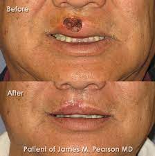 lip reconstruction dr james pearson
