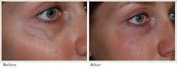 sclerotherapy under eye vein removal