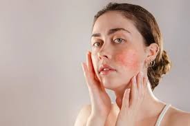 your rosacea with ipl therapy