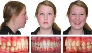 How to fix underbite in children? How To Fix Overbite Without Surgery Cardsdental