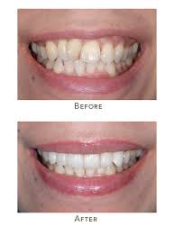 In fact, while wearing braces your teeth become harder to clean or whiten. How To Get Straight Teeth Quickly Crooked Front Teeth Solutions