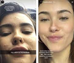 madison beer shows acne in no makeup selfie