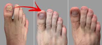 fungal toenails feet for life