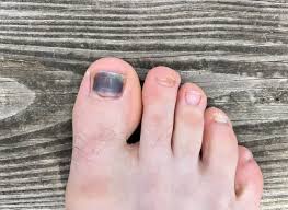 black toenail causes treatment and