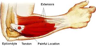 This could be overtraining from strain or repetition due to lifting too heavy weights.the worst case of forearm tendonitis occurs when the muscle is torn, which creates. Elbow Pain Causes Treatments For Tennis Elbow