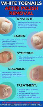 white toenails from nail polish causes