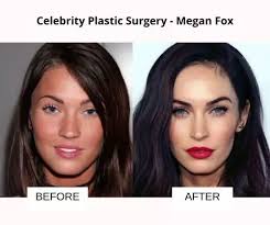 celebrity plastic surgery 51 before