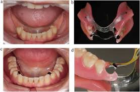 Prosthodontics Dental Materials From Conventional To